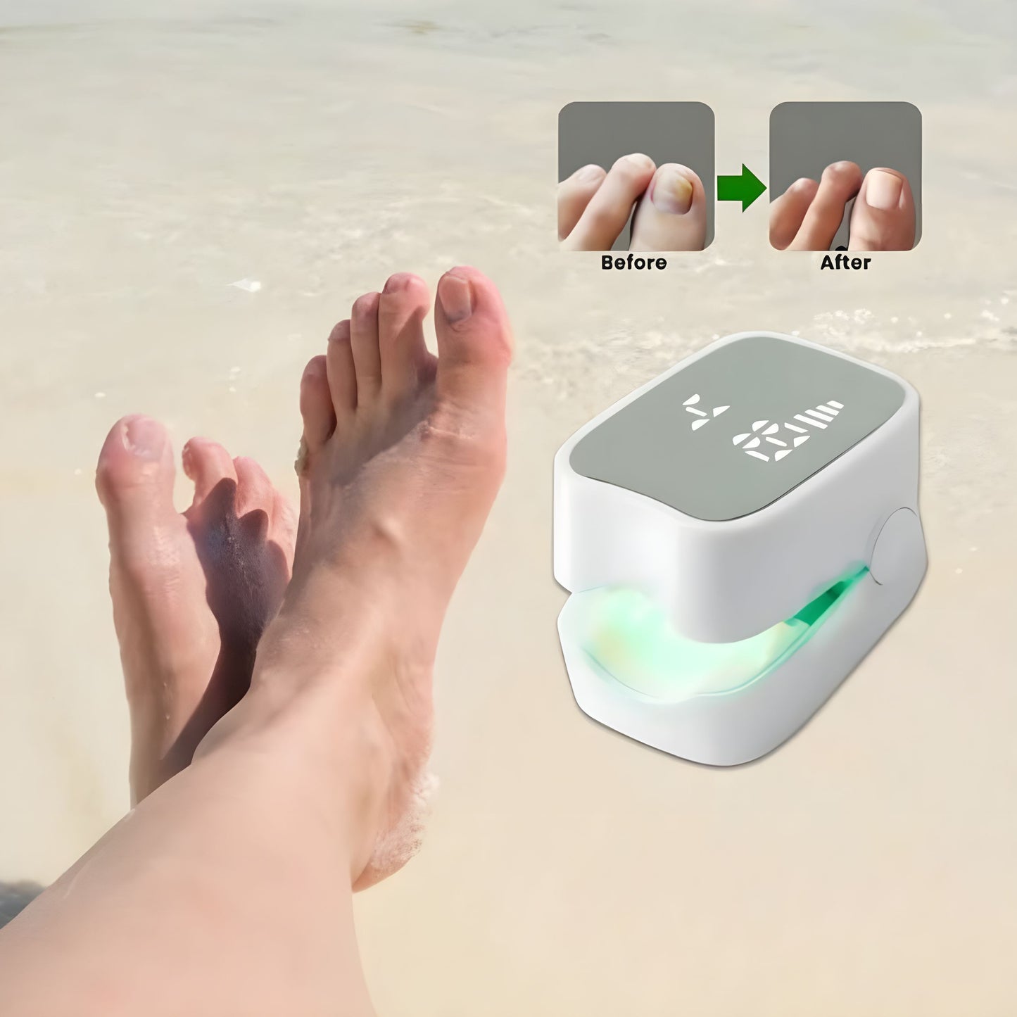 ClearToez™ | Nail Fungus Laser