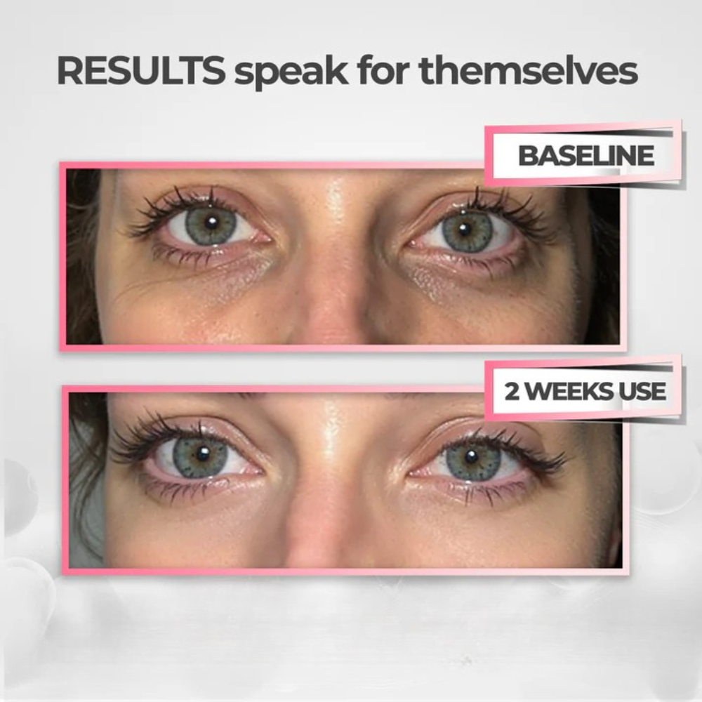 AuraEyes™ | Under-Eye Red Light Therapy