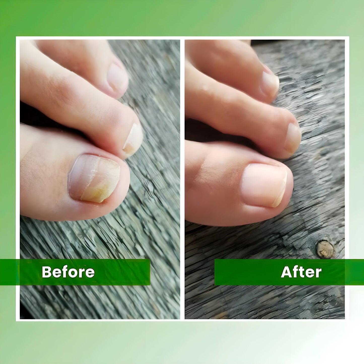ClearToez™ | Nail Fungus Laser